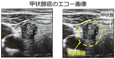 超音波検査04